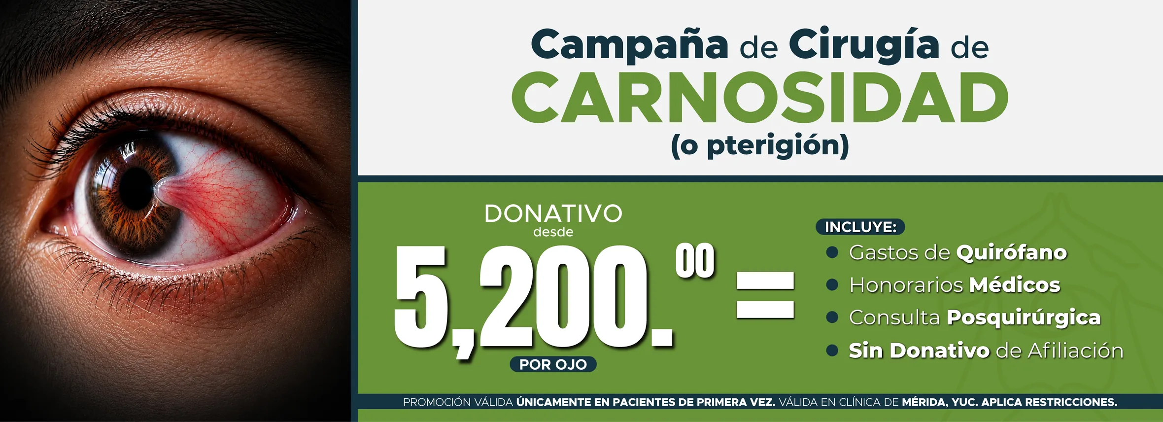 Campaña de Cirugía de Carnosidad (o pterigión): donativo desde $5,200.00 por ojo. Incluye gastos de quirófano, honorarios médicos, consulta posquirúrgica y sin donativo de afiliación. Promoción válida únicamente en pacientes de primera vez en la clínica de Mérida, Yuc. Aplica restricciones.
