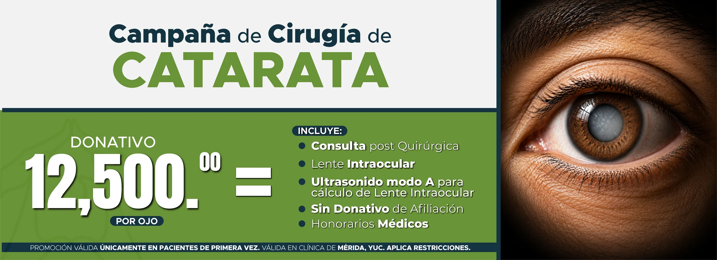 Campaña de Cirugía de Catarata: donativo de $12,500.00 por ojo. Incluye consulta post quirúrgica, lente intraocular, ultrasonido modo A para cálculo de lente intraocular, sin donativo de afiliación y honorarios médicos. Promoción válida únicamente en pacientes de primera vez en la clínica de Mérida, Yuc. Aplica restricciones.